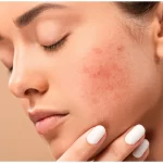 3 Tips which will help to Remove Post Acne Marks and Dark Spots